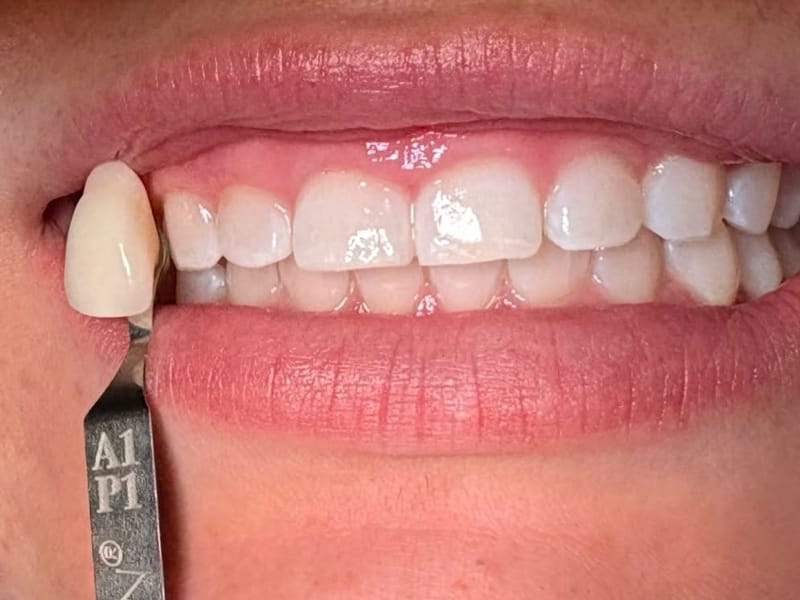 The same smile after professional whitening, matched to shade A1 on the shade guide