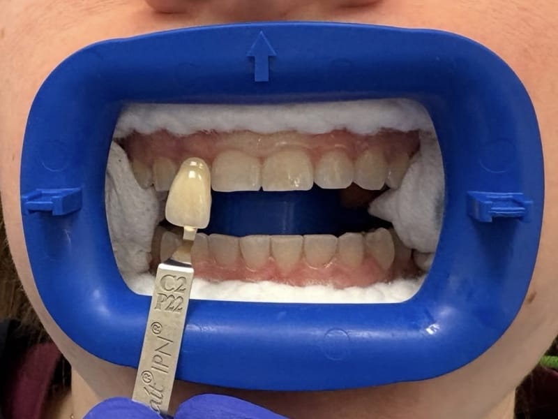 Teeth before professional whitening, matched to shade C2 on the shade guide