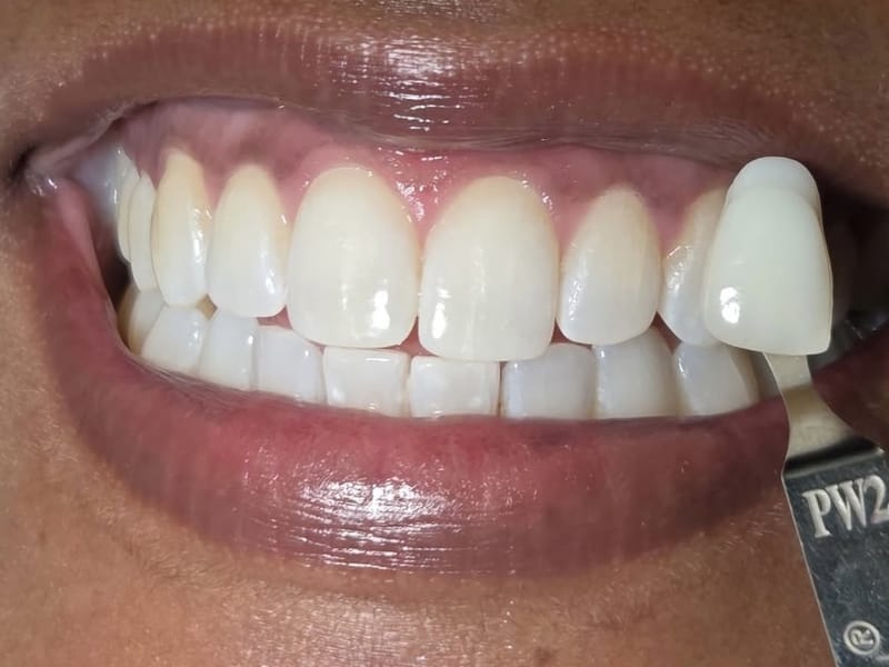 The same smile after professional whitening, brightened past the natural shade range