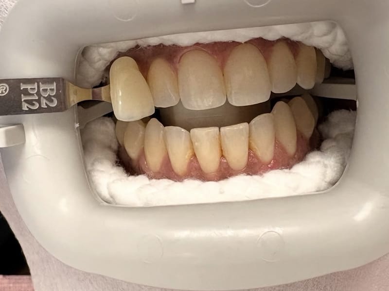 Teeth before professional whitening, matched to shade B2 on the shade guide
