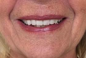 Implant Smile Gallery - Manotick