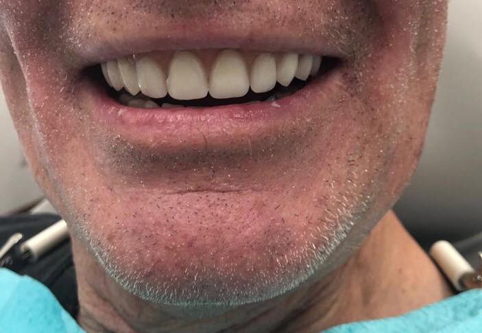 Implant Smile Gallery - Manotick